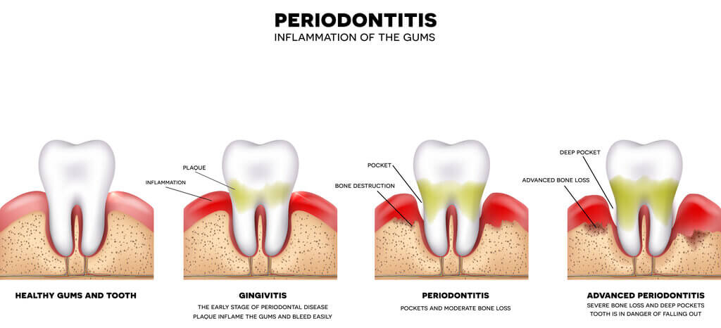 Advanced Dental Bone Loss Due To Gum Disease