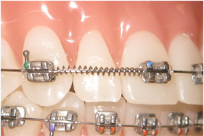 What To Know About Metal Braces?