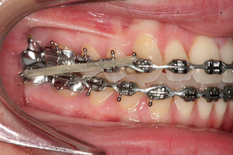 overbite correction braces