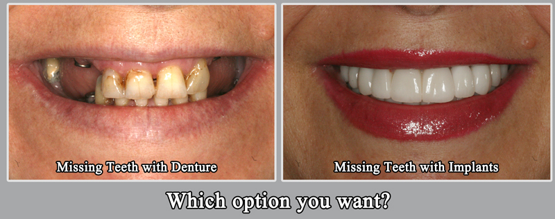 How to Phase Dental Treatment  NOLA Dentures & General Dentistry