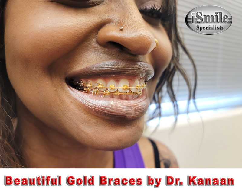 Gold braces houston on a patient