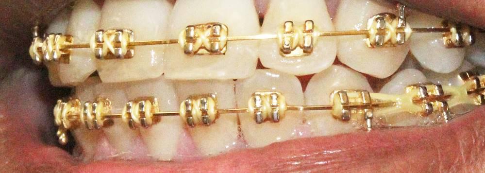 gold braces mint dentistry