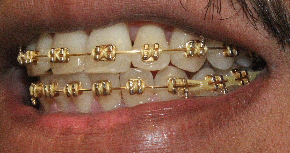 affordable-gold-braces-in-houston-and-sugar-land