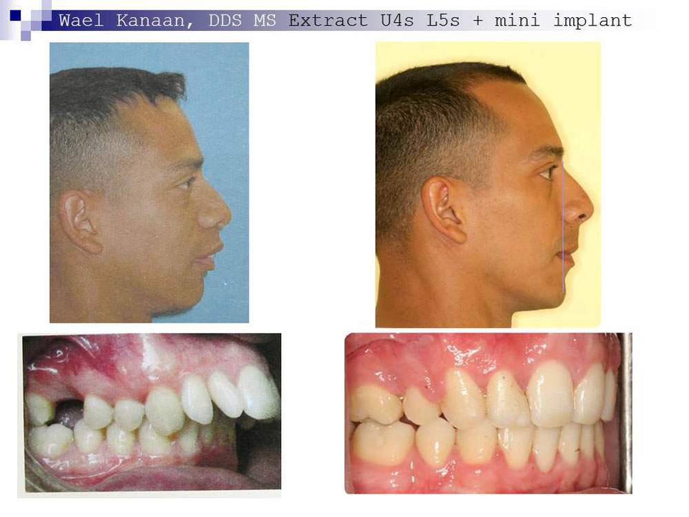 Overbite Correction in Houston and Sugarland TX - iSmile