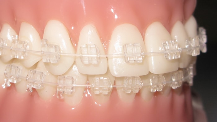 Ceramic Brackets (Clear Braces) - Align Orthodontics : Align Orthodontics