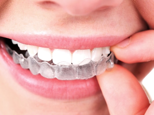 Clear Braces: What Are They? - Karrie Chu DDS Dental Care Pasadena  California