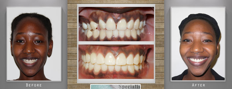 Orthodontics - Invisalign Before & After - Orthodontic therapy Ismile