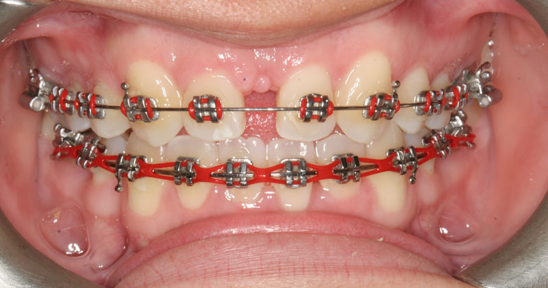 Braces