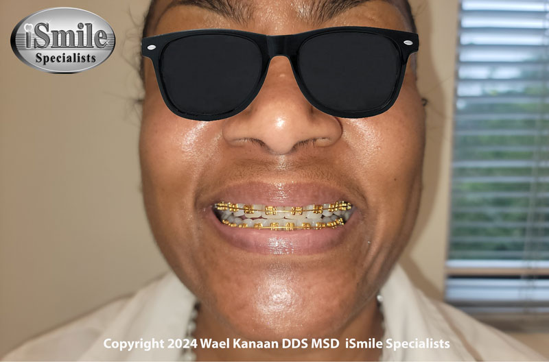 A patient in treatment for 14 months with Gold Bracesd 