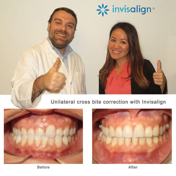 Invisalign: The first days of trays - Sugar Fix Dental Loft