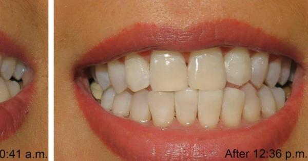 teeth whitening class houston